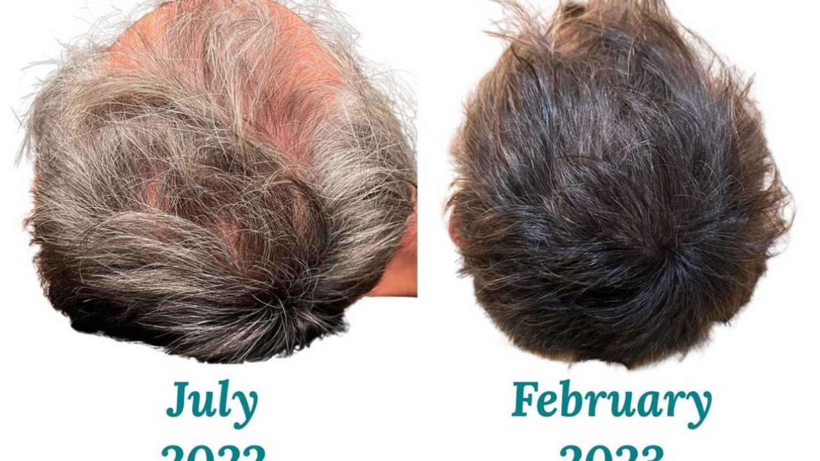 hair loss treatment. hair restoration results