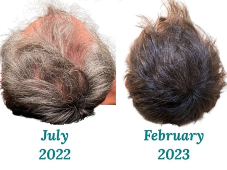 Hair loss treatment. Hair restoration results